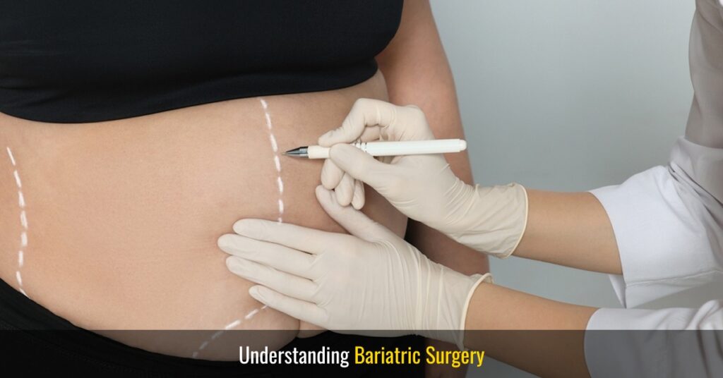 understanding bariatric surgery